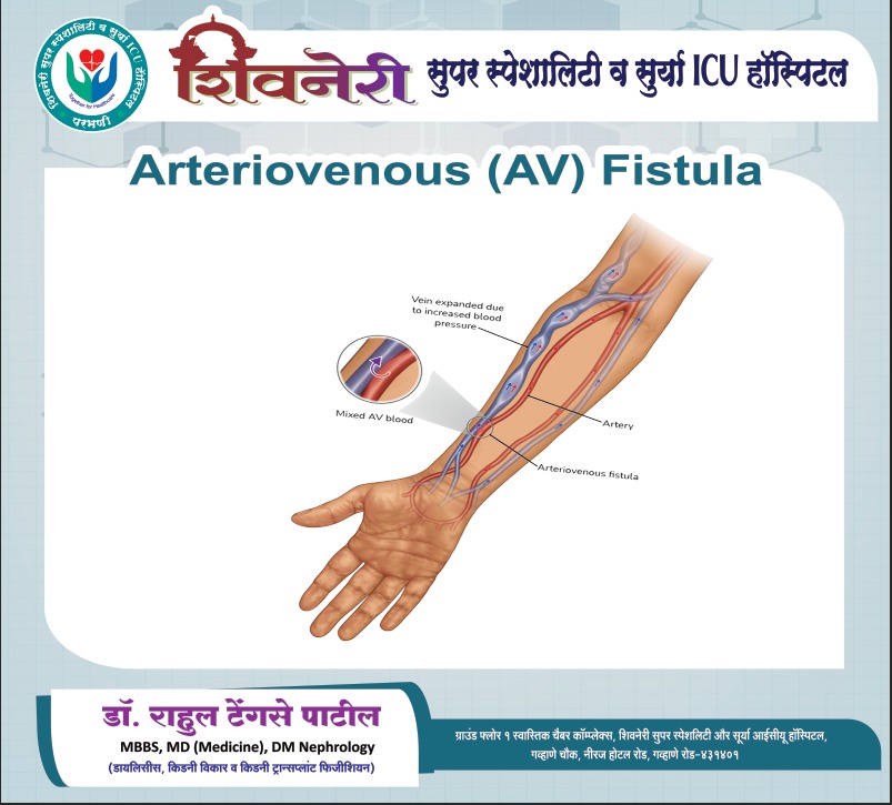 Arteriovenous (AV) Fistula — dialysis access, Shivneri Super Speciality & Surya ICU Hospital
